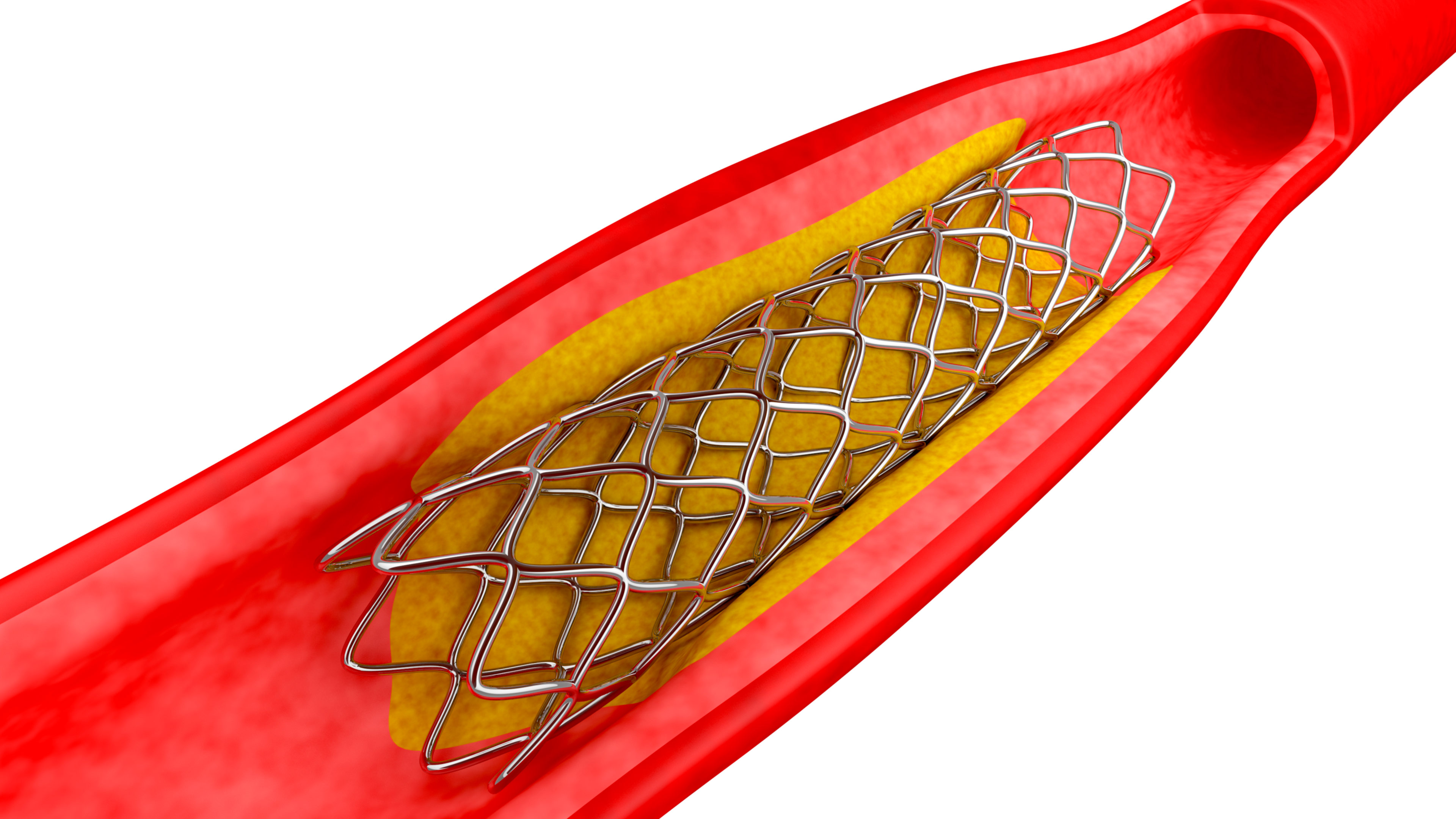 What is the average recovery time after a heart stent?